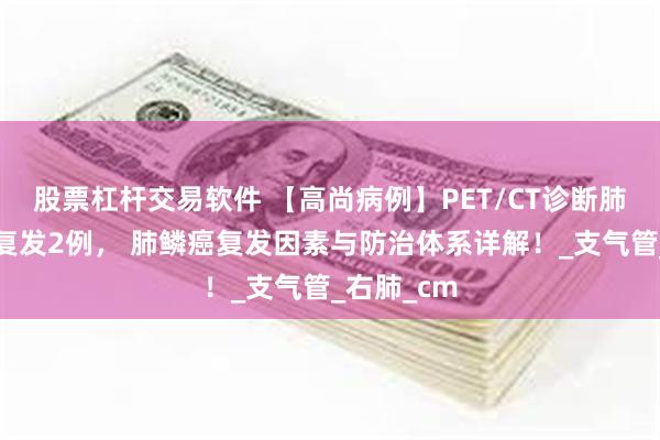 股票杠杆交易软件 【高尚病例】PET/CT诊断肺鳞癌术后复发2例， 肺鳞癌复发因素与防治体系详解！_支气管_右肺_cm